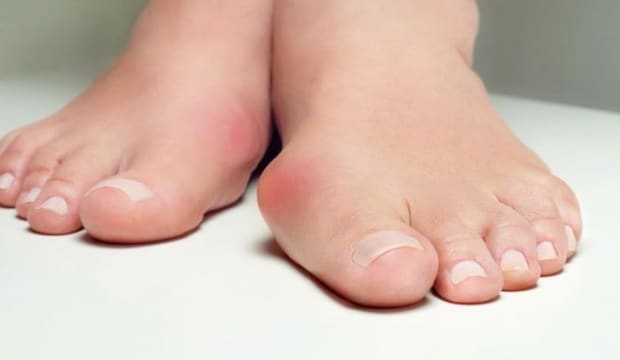 ayak ustunde kemik cikintisi nedenleri ayak kemigi cikintisi tedavisi 1570002806 9122
